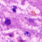 06 アデノウィルス感染症の肝臓組織